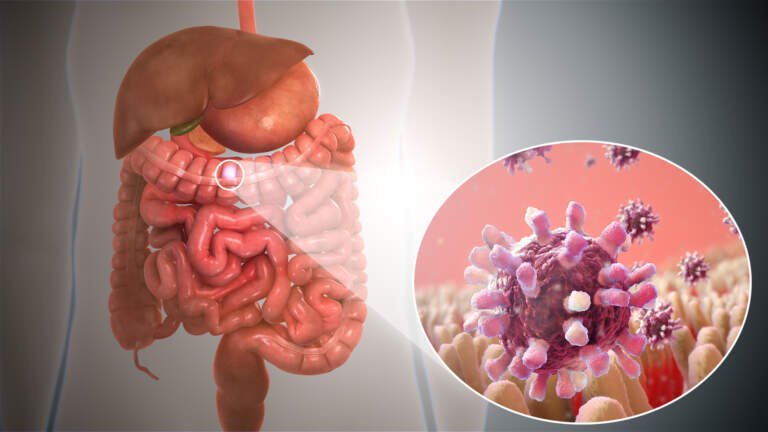 Effective Gastroenteritis Treatment Options Available in Dubai