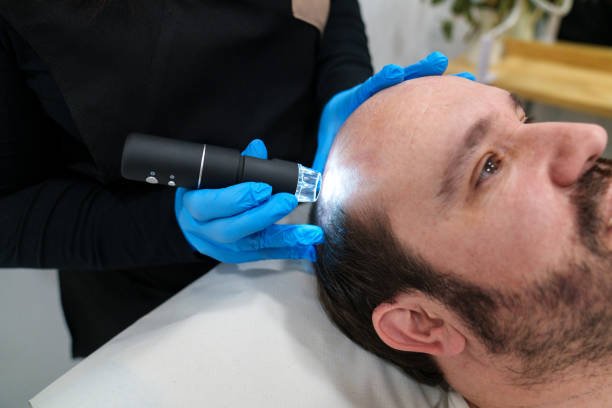 Choosing the Right Hair Loss Treatment in Renton : Free Guide