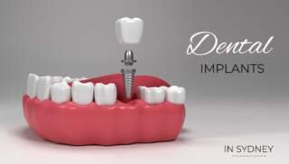 Why Dental Implant Prices Vary Across Sydney Clinics