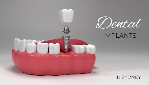 Why Dental Implant Prices Vary Across Sydney Clinics