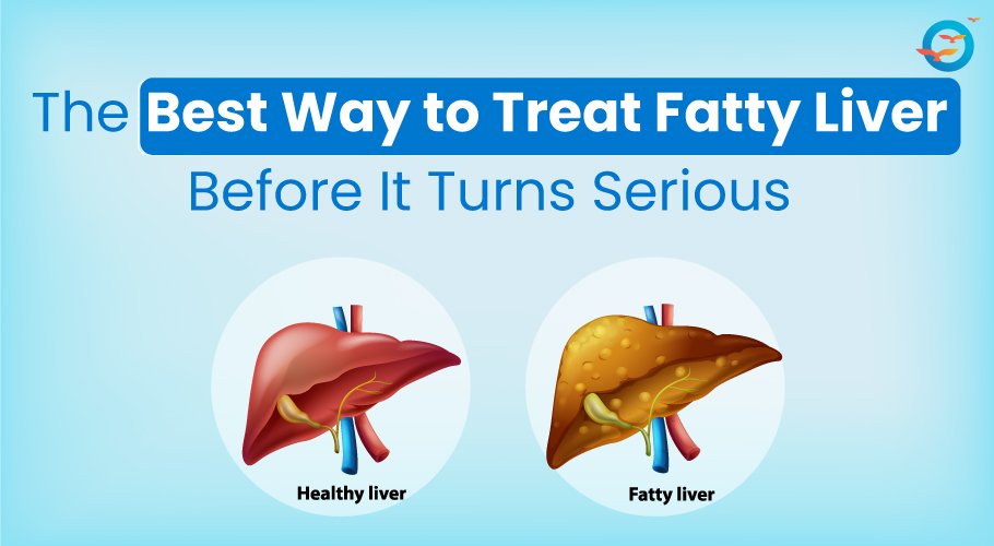 The Best Way to Treat Fatty Liver Before It Turns Serious
