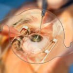 Cataract Surgeon Dubai: What Patients Should Know Before Surgery