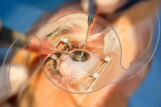 Cataract Surgeon Dubai: What Patients Should Know Before Surgery
