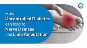 How Uncontrolled Diabetes Can Lead to Nerve Damage and Limb Amputation?