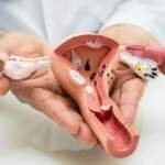 Finding an Endometriosis Specialist Dubai for Ongoing Care